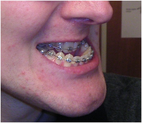 Recent Advances in Teeth Alignment